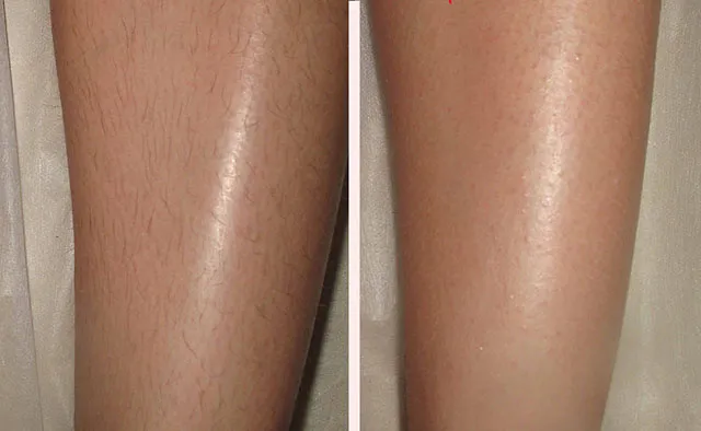 Удаление волос на ногах: до и после