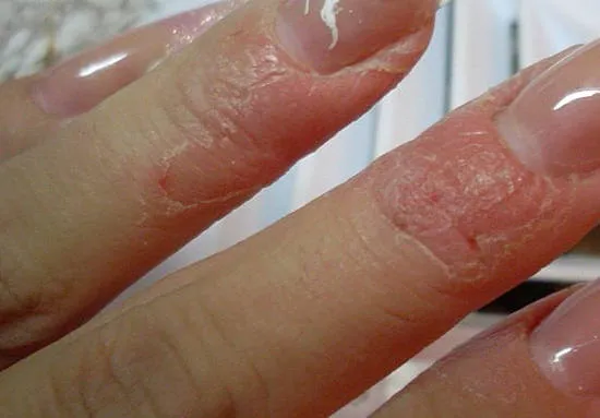Аллергия на обезжириватель для ногтей