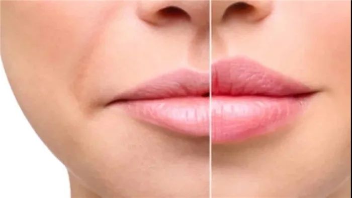 Визуальное увеличение губ