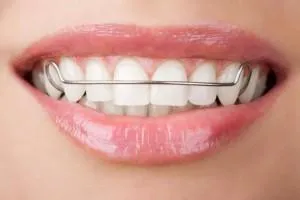 Трейнеры и пластины для выпрямления зубов