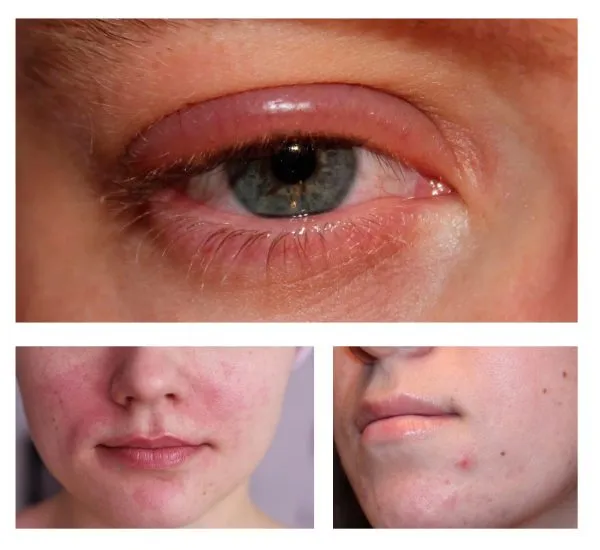 Примеры аллергических реакций кожи